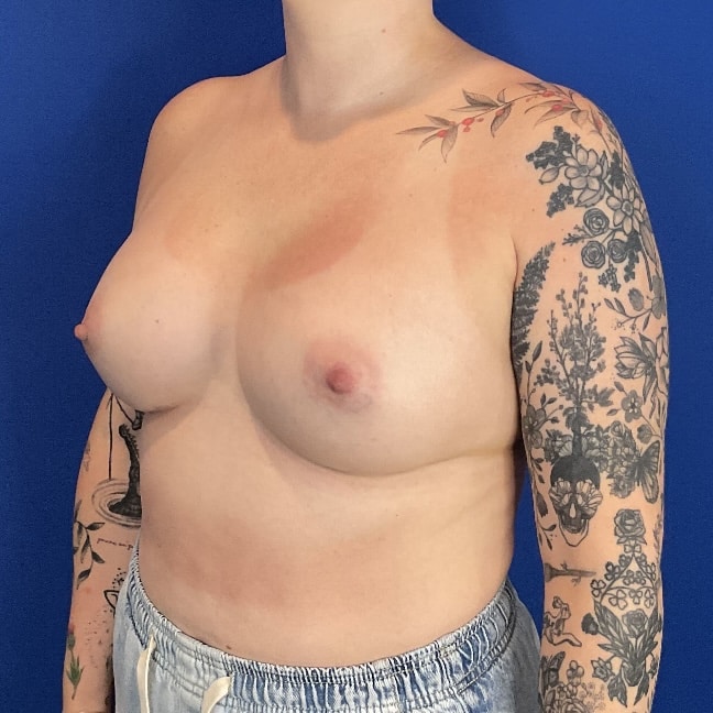 After Image: Patient Case #7040 - left-front-oblique