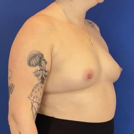 Before Image: Patient Case #7040 - right-front-oblique