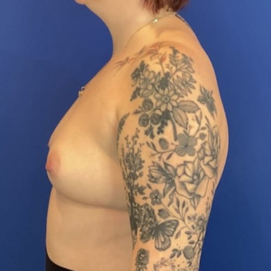 Before Image: Patient Case #7040 - left-side