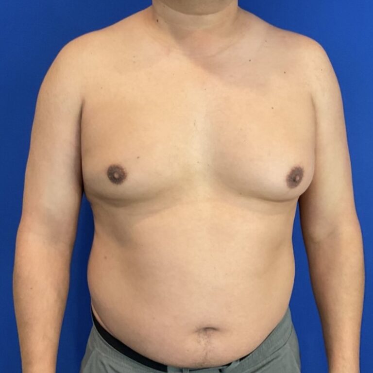 Before Image: Patient Case #7061 - front