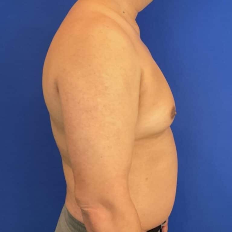 Before Image: Patient Case #7061 - right-side