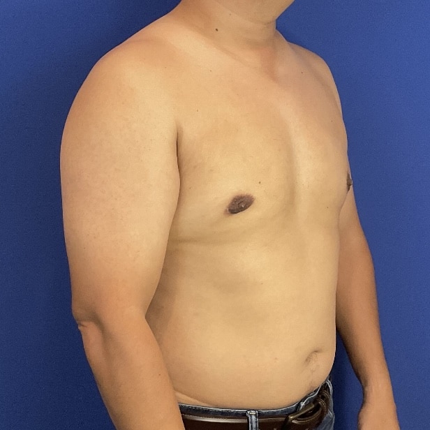 After Image: Patient Case #7061 - right-front-oblique