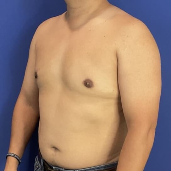 After Image: Patient Case #7061 - left-front-oblique