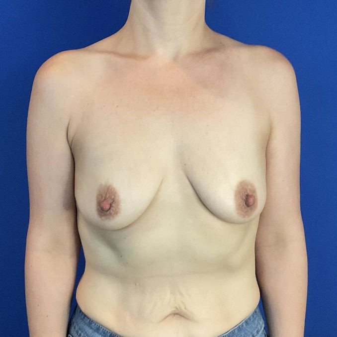 Before Image: Patient Case #7097 - front