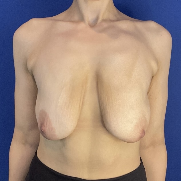 Before Image: Patient Case #7129 - front