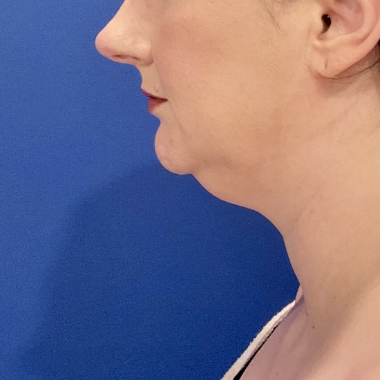 Before Image: Patient Case #7108 - left-side