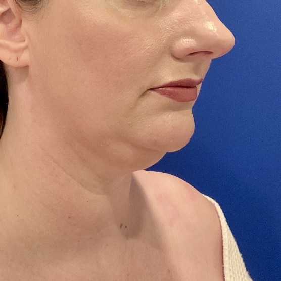 Before Image: Patient Case #7108 - right-front-oblique