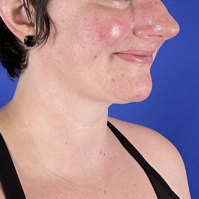 After Image: Patient Case #7108 - right-front-oblique