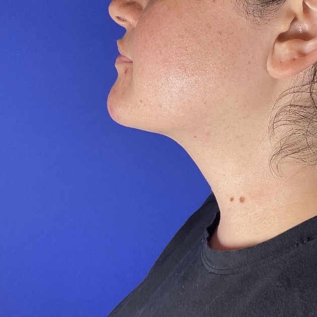 After Image: Patient Case #7130 - left-side