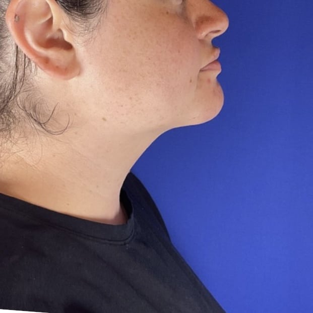 After Image: Patient Case #7130 - right-side