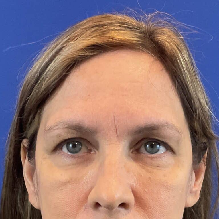 Before Image: Patient Case #6820 - front