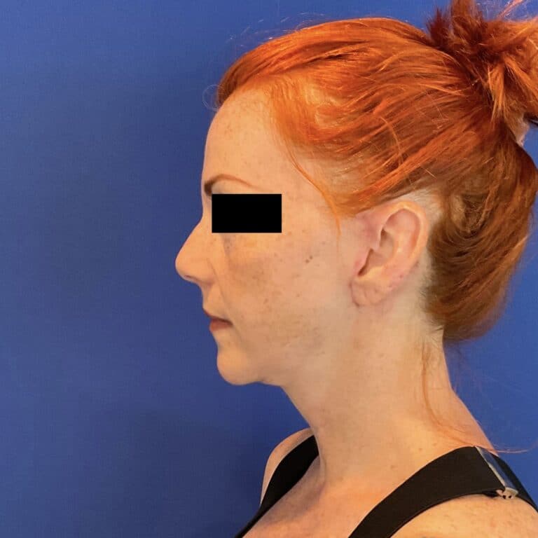 After Image: Patient Case #6767 - left-side