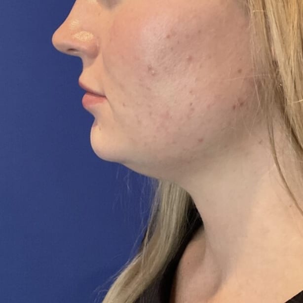 Before Image: Patient Case #7140 - left-side