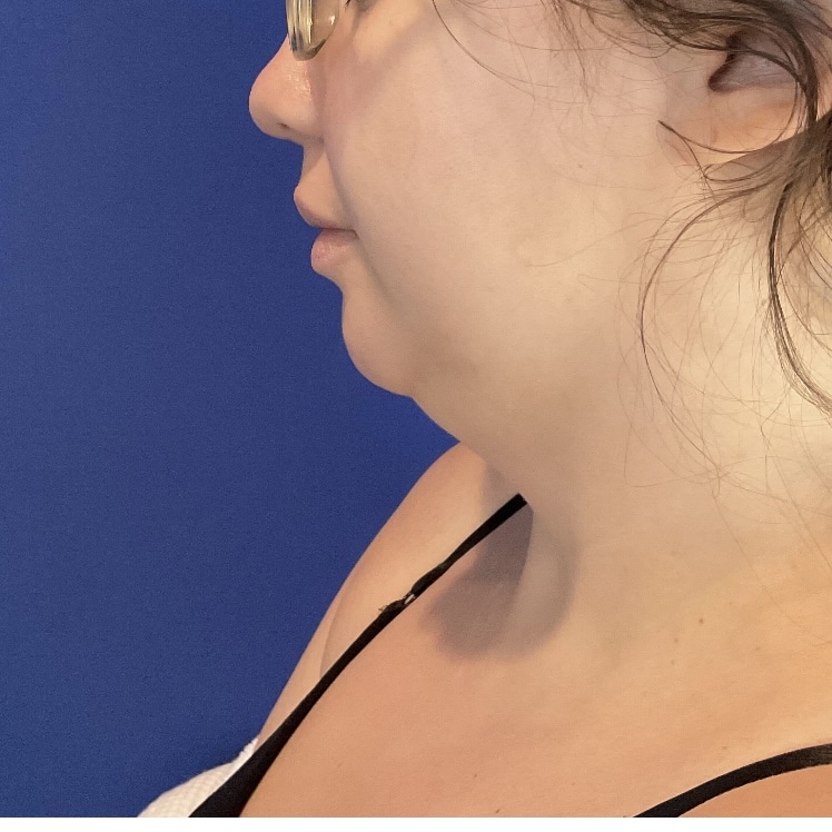 Before Image: Patient Case #7146 - left-side