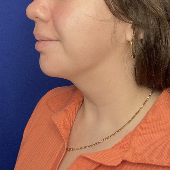 After Image: Patient Case #7146 - left-front-oblique