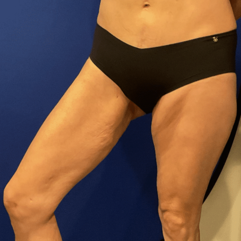 Before Image: Patient Case #7193 - left-front-oblique