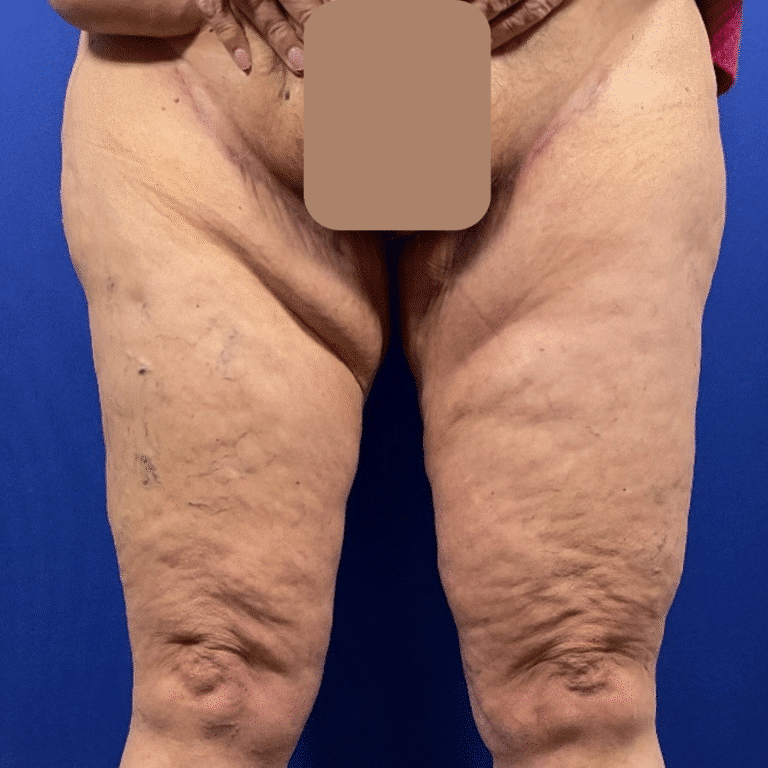 After Image: Patient Case #7184 - front